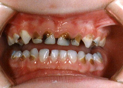 what causes kids to have yellow teeth