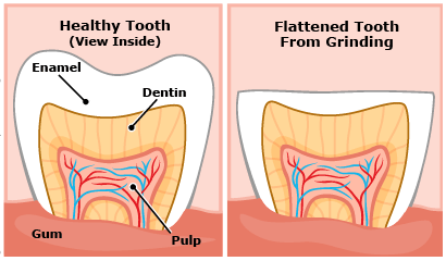 teeth grinding enamel