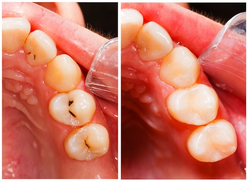 How Long Does It Take To Fill A Cavity On A Child